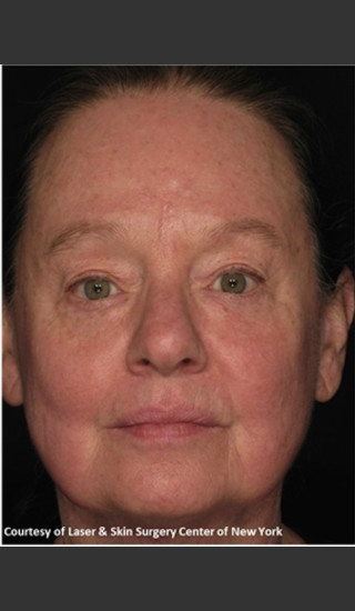 After Photo for Full face Treament with Fraxel - Roy G. Geronemus, M.D. - Prejuvenation