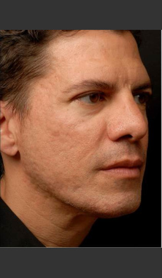 After Photo for Infini Acne Scar Treatment -  - Prejuvenation