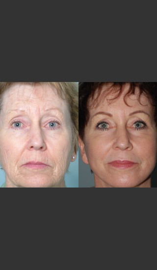 Before Photo for Full Face Rejuvenation - Mark B. Taylor, M.D. - Prejuvenation
