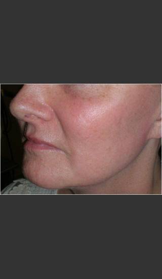 After Photo for Sun Damage and Acne Scarring - Christopher B. Zachary, MD - Prejuvenation