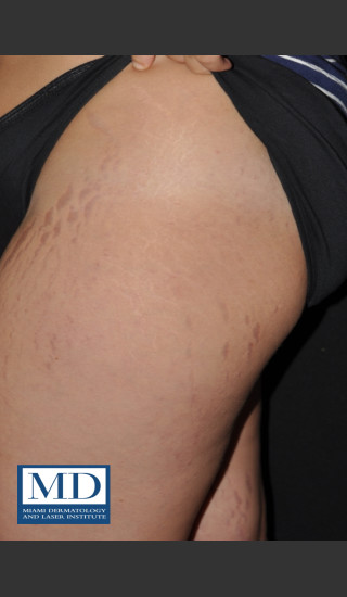 After Photo for Striae Treatment 127 - Jill S. Waibel, MD - Prejuvenation