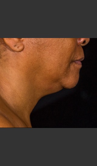 Before Photo for SculpSure Submental - Bruce E Katz, M.D. - Prejuvenation