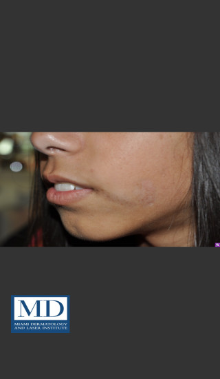 After Photo for Birthmark Cafe Au Lait Macule Treatment 112 - Jill S. Waibel, MD - Prejuvenation