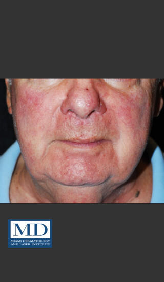 After Photo for Rosacea Treatment 102 - Jill S. Waibel, MD - Prejuvenation