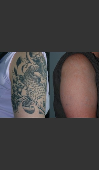 Before Photo for Tattoo Removal - Mark B. Taylor, M.D. - Prejuvenation