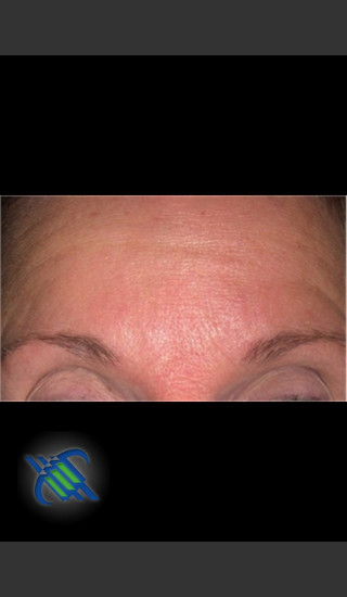 Before Photo for Treatment of Fine lines and Wrinkles - Roy G. Geronemus, M.D. - Prejuvenation