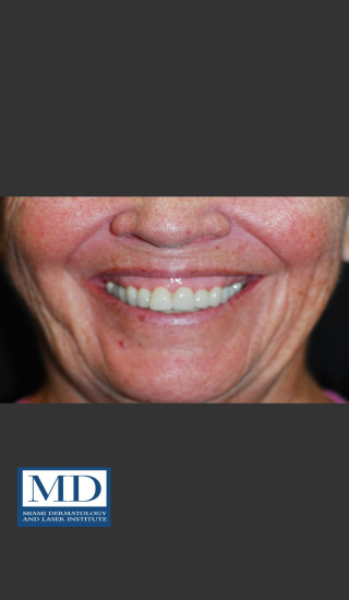 Before Photo for Neurotoxin Gummy Smile 129 - Jill S. Waibel, MD - Prejuvenation