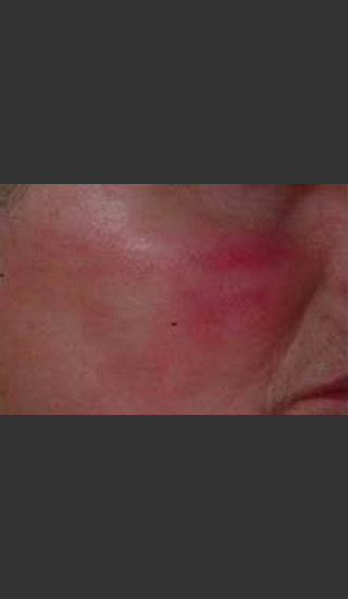 After Photo for IPL Treatment #19 - Harvey H. Jay, M.D. - Prejuvenation