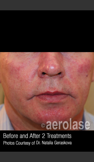 Before Photo for Treatment of Facial Blood Vessels #324 -  - Prejuvenation