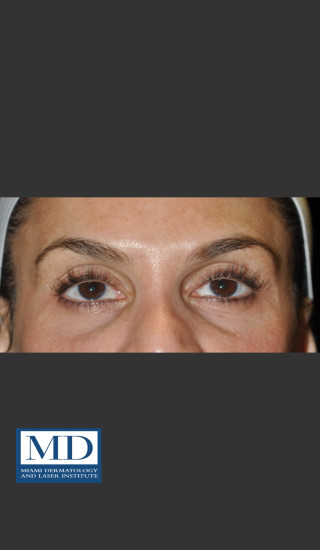 Before Photo for Midfacial Filler 136 - Jill S. Waibel, MD - Prejuvenation