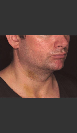 After Photo for Treatment of Neck Contour -  - Prejuvenation