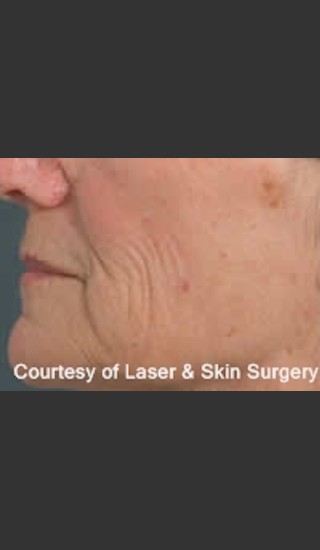 Before Photo for Treatment of Lines and Wrinkles with Fraxel - Roy G. Geronemus, M.D. - Prejuvenation