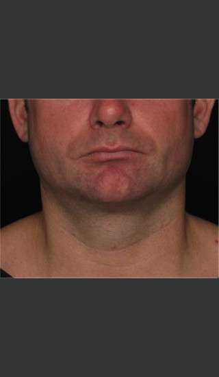 After Photo for Treatment of Neck with Laser Liposuction -  - Prejuvenation