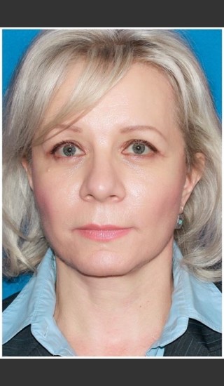 After Photo for Facelift - Case 8 - Konstantin Vasyukevich, MD - Prejuvenation