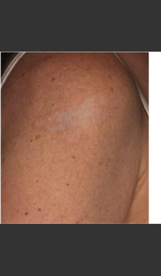 After Photo for Treatment of Shoulder Tattoo - Roy G. Geronemus, M.D. - Prejuvenation