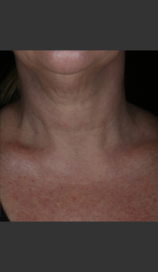 After Photo for Alastin Skincare Restorative Neck Complex with TriHex Technology® -  - Prejuvenation