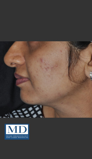 Before Photo for Post Inflammatory Hyperpigmentation 120 - Jill S. Waibel, MD - Prejuvenation