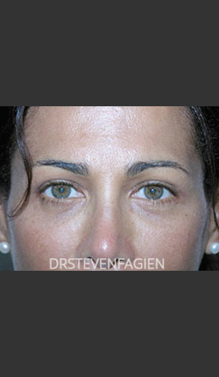 After Photo for Blepharoplasty - Patient 2 - Steven Fagien, MD - Prejuvenation