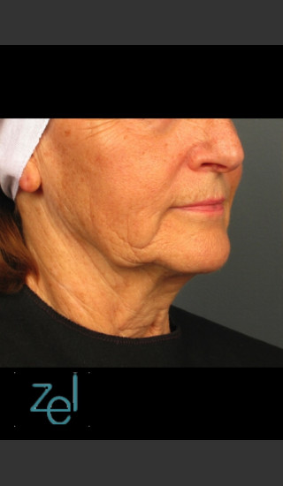 Before Photo for Lower Face Ultherapy & Dermal Fillers - Brian D. Zelickson, M.D. - Prejuvenation