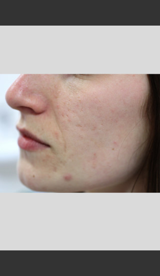 Before Photo for Sublative Rejuvenation Treatment -  - Prejuvenation