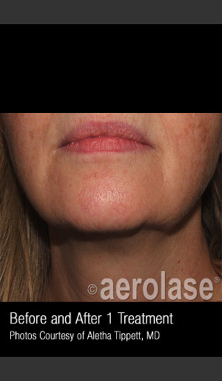 Before Photo for Skin Tightening #347 -  - Prejuvenation