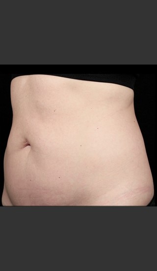 After Photo for SculpSure Abdomen - Sean Doherty - Prejuvenation