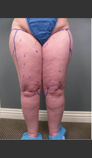 Before Photo for Circumferential Liposuction #46 - Dr. David Amron - Prejuvenation
