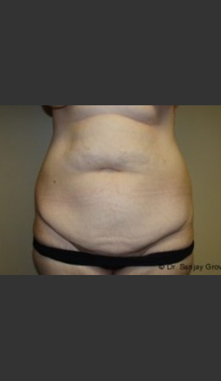 Before Photo for Tummy Tuck 7163 - Sanjay Grover MD FACS - Prejuvenation