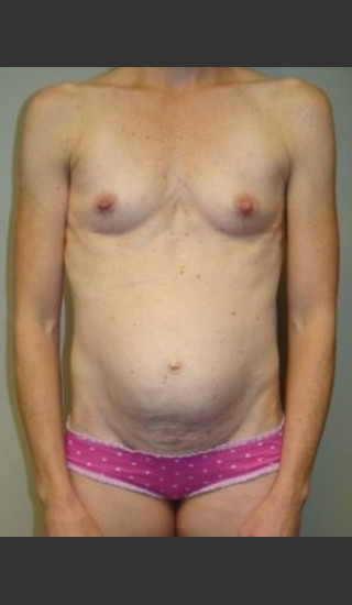 Before Photo for Mommy Makeover 8468 - Sanjay Grover MD FACS - Prejuvenation