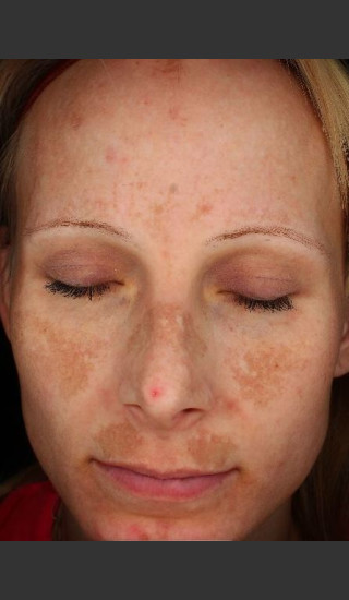 Before Photo for Photoaging and Melasma  - Paul M. Friedman, M.D. - Prejuvenation