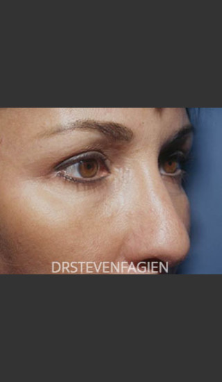 After Photo for Blepharoplasty - Patient 1 - Steven Fagien, MD - Prejuvenation