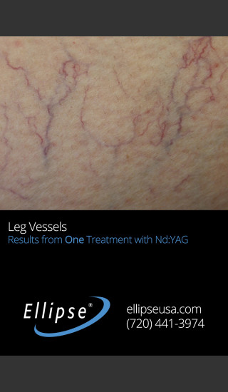 Before Photo for 21 Weeks Single Leg Vein Treatment -  - Prejuvenation