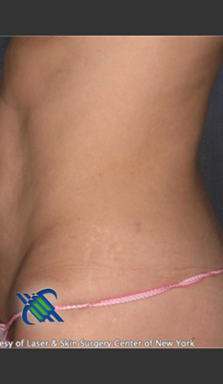 After Photo for VelaShape Treatment of Abdomen - Roy G. Geronemus, M.D. - Prejuvenation