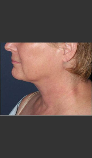 After Photo for Facial Liposculpture - William F. Groff, M.D. - Prejuvenation