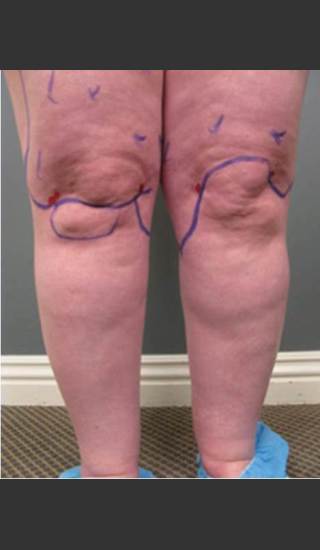 Before Photo for Circumferential Liposuction #45 - Dr. David Amron - Prejuvenation