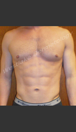 After Photo for SmartLipo Liposuction of Male Abdomen - Gregory A Nikolaidis - Prejuvenation
