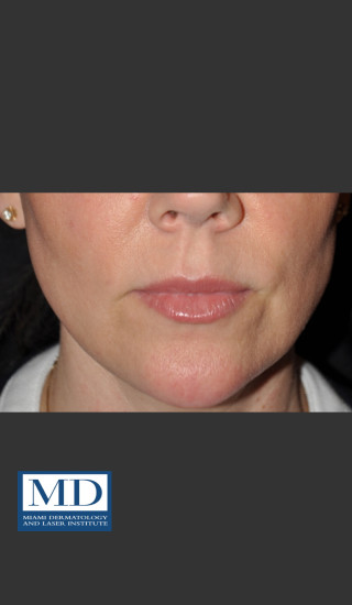 After Photo for Lip Filler 135 - Jill S. Waibel, MD - Prejuvenation