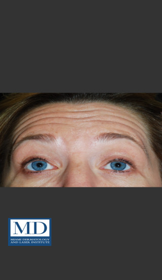 Before Photo for Neurotoxin Treatment of Forehead 130 - Jill S. Waibel, MD - Prejuvenation