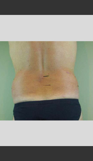 After Photo for UltraShape Focused Ultrasound of Male Flanks -  - Prejuvenation