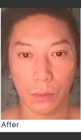 After Photo for Sculptra for Male Facial Rejuvenation - Annie Chiu, MD - Prejuvenation