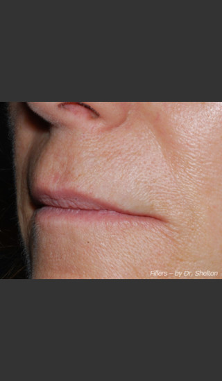 After Photo for Treatment of Perioral Wrinkles - Ron M. Shelton, M.D. - Prejuvenation