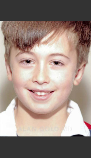 After Photo for Otoplasty Case 114 - Alan Gold MD - Prejuvenation