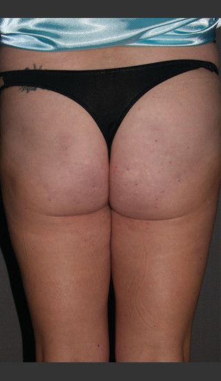 After Photo for Cellfina Case #1 - South Coast Plastic Surgery - Prejuvenation