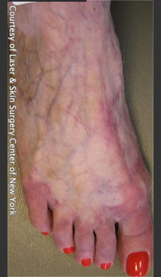 After Photo for Treatment of Foot Leg Veins -  - Prejuvenation