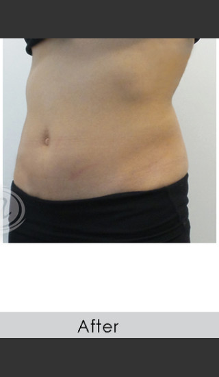 After Photo for CoolSculpting+ Abdomen Treatment - Annie Chiu, MD - Prejuvenation