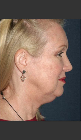 Before Photo for Non-invasive Chin Contouring - Dr. Sabrina G. Fabi - Prejuvenation