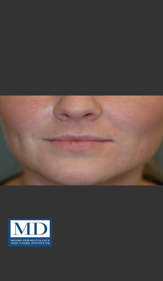 Before Photo for Lip Filler 134 - Jill S. Waibel, MD - Prejuvenation