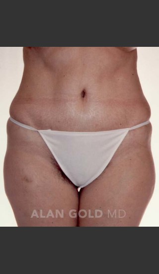 After Photo for Abdominoplasty 293 - Alan Gold MD - Prejuvenation