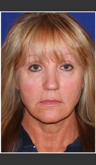 Before Photo for Facelift - Case 30 - Konstantin Vasyukevich, MD - Prejuvenation