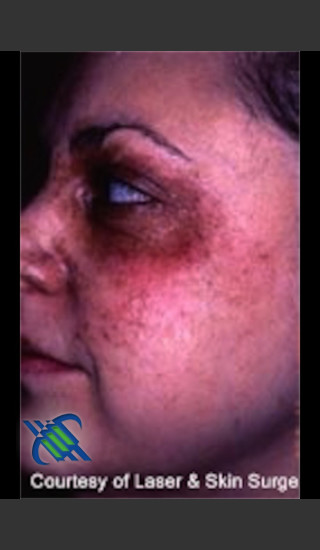 Before Photo for Treatment of Facial  Cafe au Lait - Roy G. Geronemus, M.D. - Prejuvenation
